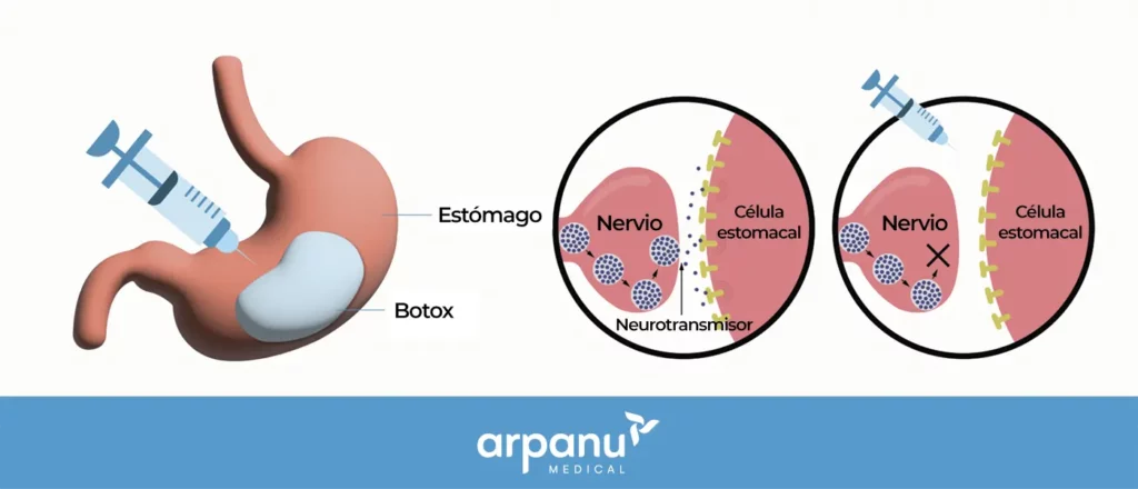 Stomach Botox Details-Es
