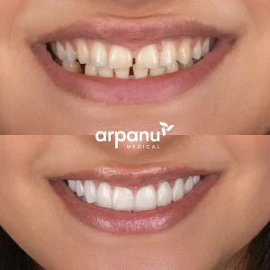 17 laminate veneers 5 emax crowns