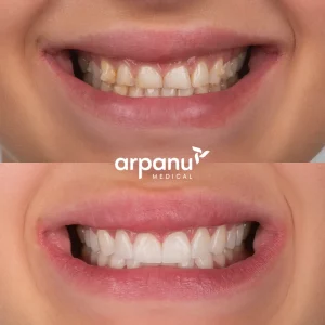 alina laminate veneers