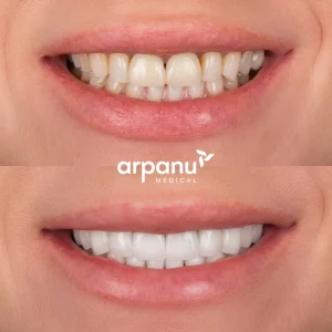 lynda laminate veneers