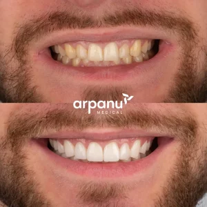mateusz 20 emax laminate veneers