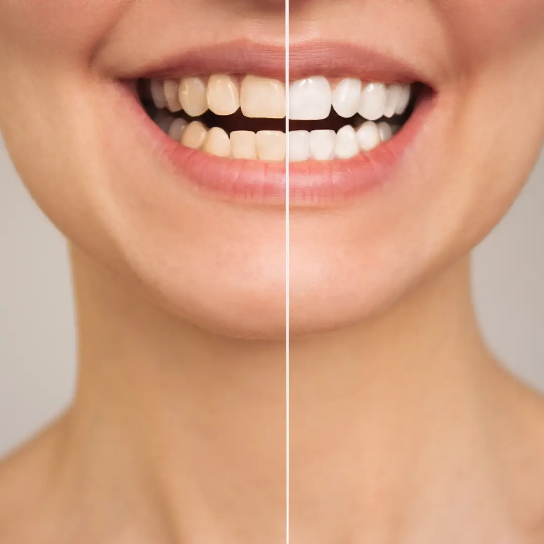 Teeth-Whitening-In-Turkey (5)