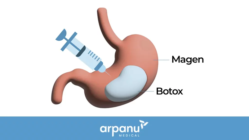 Stomach Botox-De