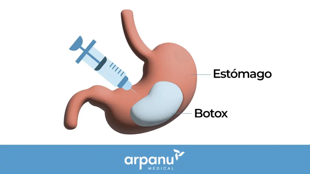 Stomach Botox-Es
